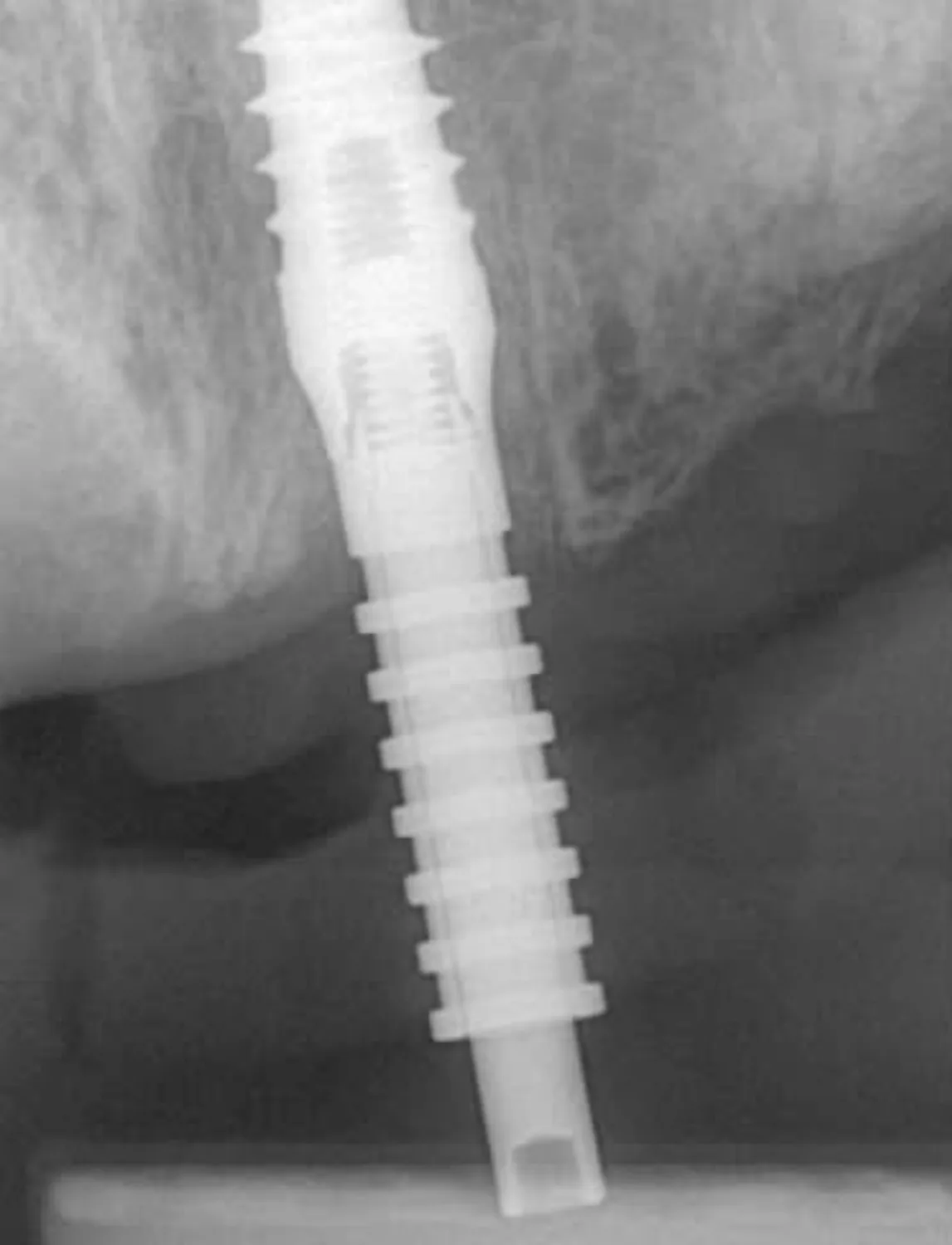 Rendgenska snimka dentalnog implantata