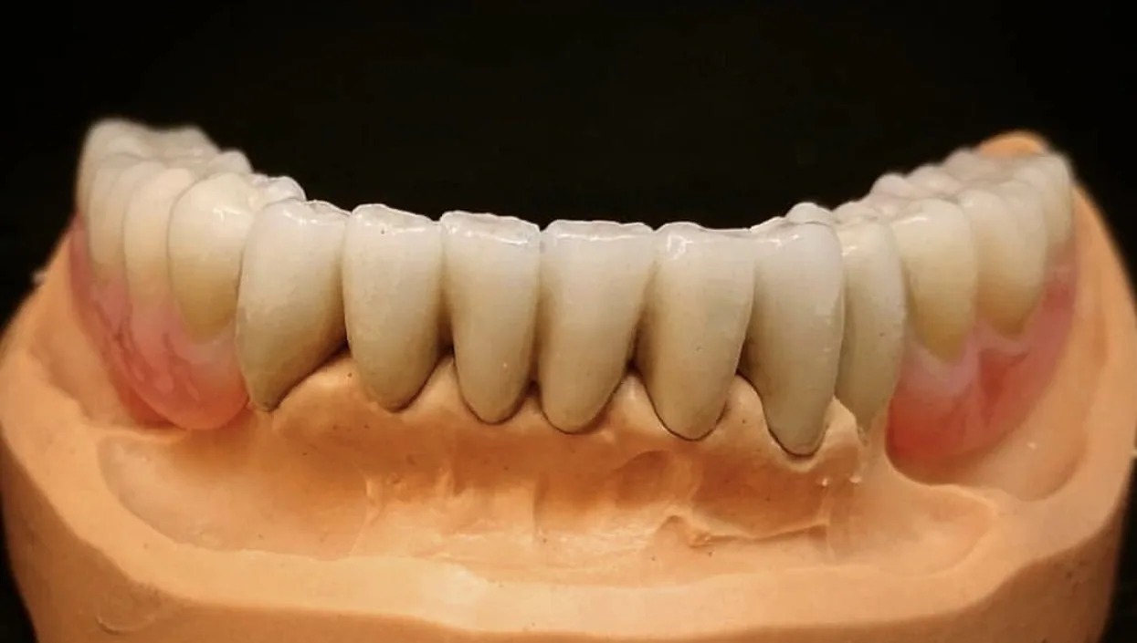 Fotografija protetskog rada na dentalnom modelu